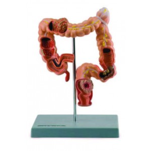 Pathological Model of Colon and Rectum